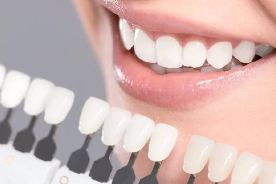 Advantages of dental laminates