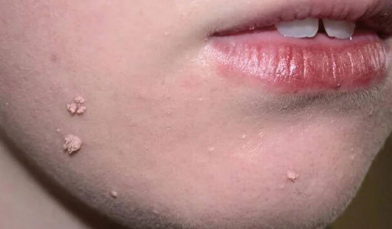 نحوه تزریق واکسن زگیل تناسلی