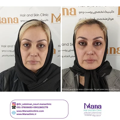 قبل و بعد جراحی پلک 