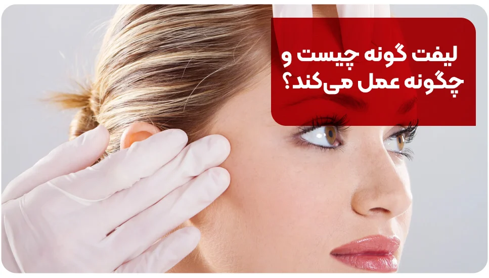 لیفت گونه چیست و چگونه عمل میکند؟