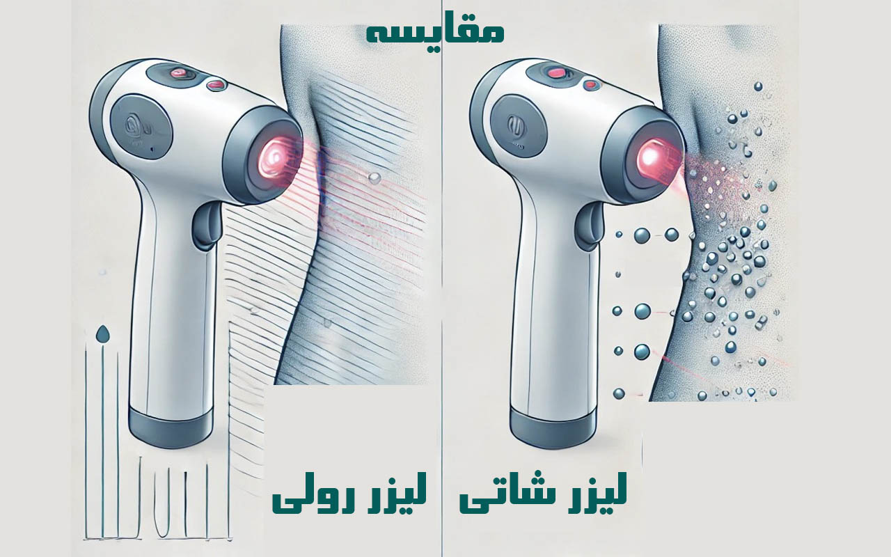 لیزر شاتی یا رولی