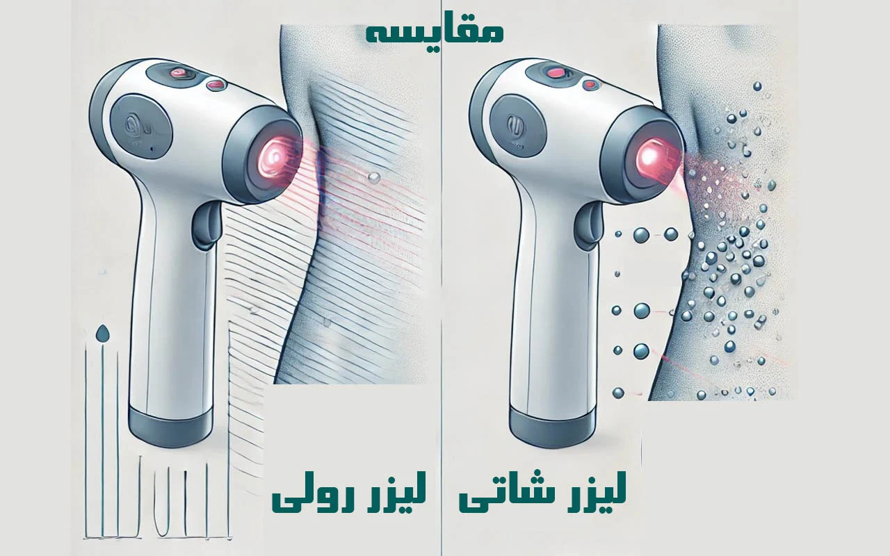 لیزر شاتی یا رولی